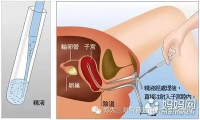 ​几张图揭开人工授精助孕手术的神秘面纱