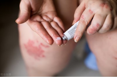 ​皮炎用什么药膏好得快（治疗特应性皮炎，他克莫司软膏效果好吗？这篇文章