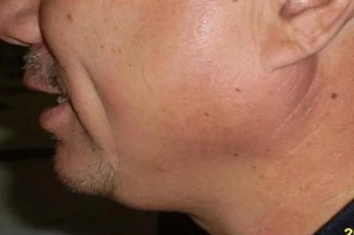 ​腮腺炎的症状图片