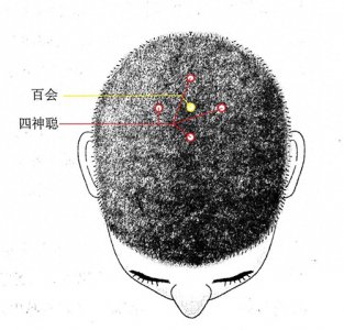 ​四神聪穴的妙用